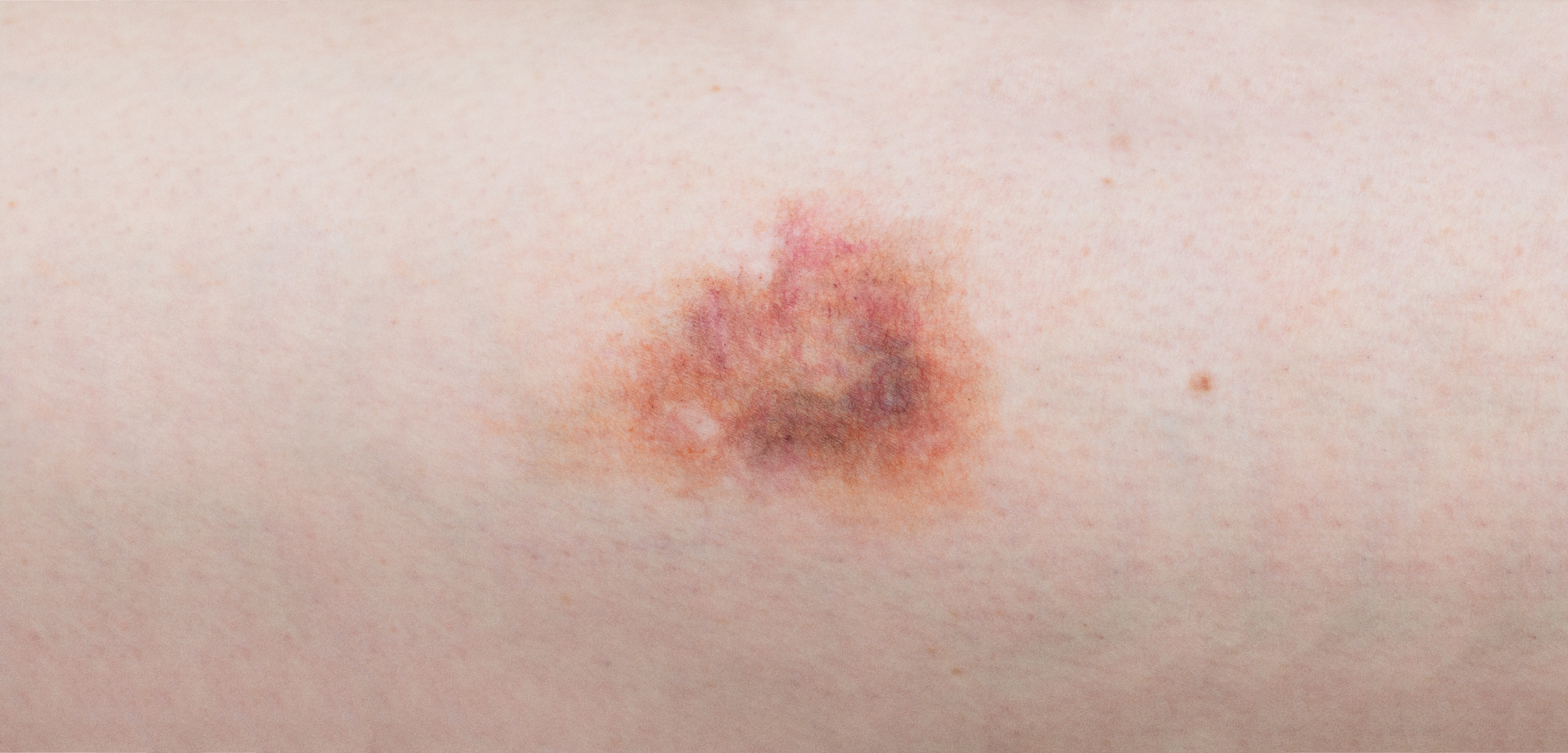 Hematoma from the Archive of versorgen (WT)  with: Judith Weidmann (bodily presence), Julia Nietlispach (SFX Makeup), Nora Longatti (Image)